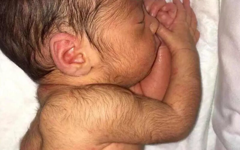 Bebés con “síndrome del hombre lobo”: el insólito efecto secundario del minoxidil